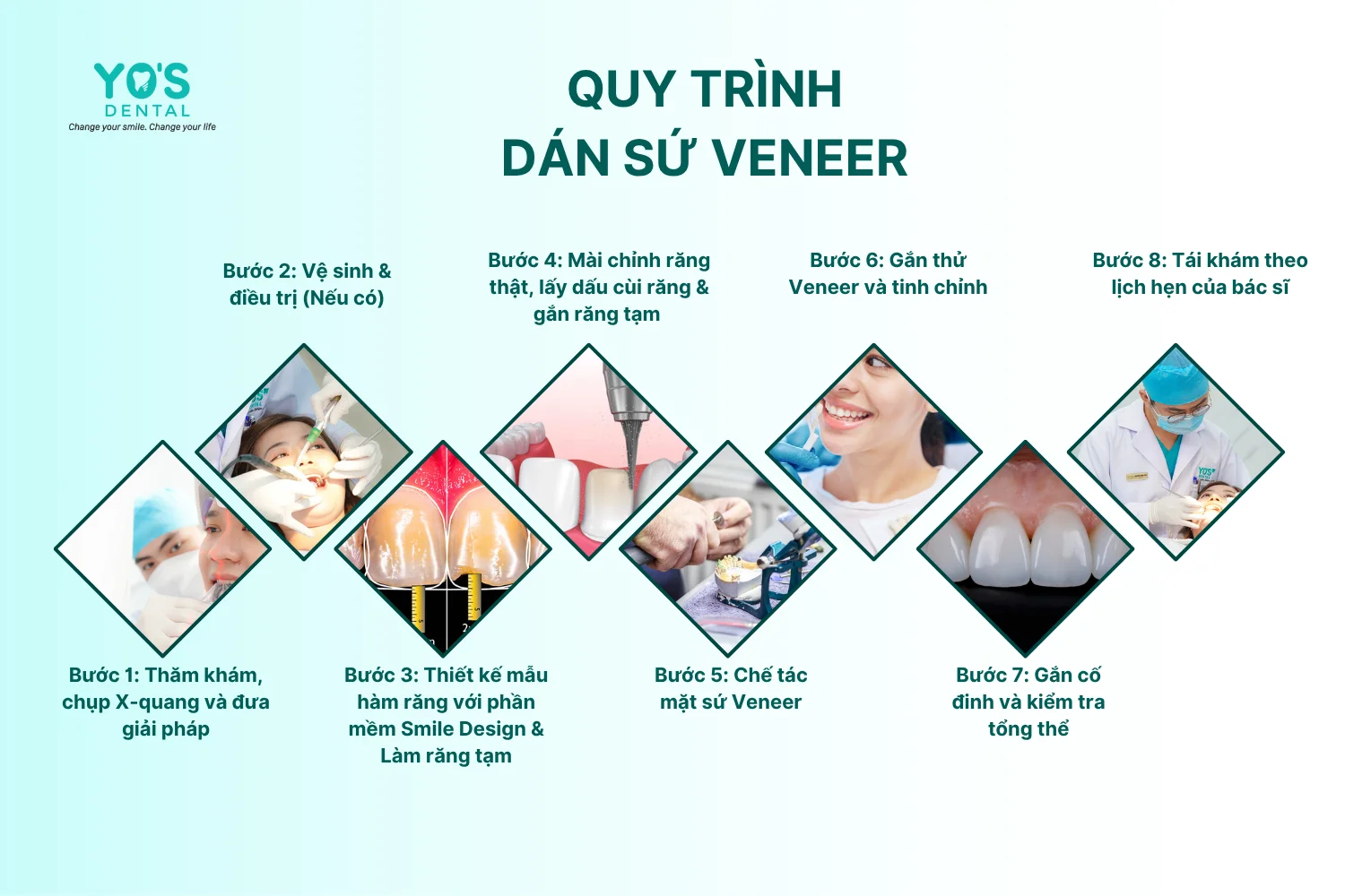 Quy trình dán sứ Veneer tại Nha khoa Sài Gòn Bình Dương Yo's Dental