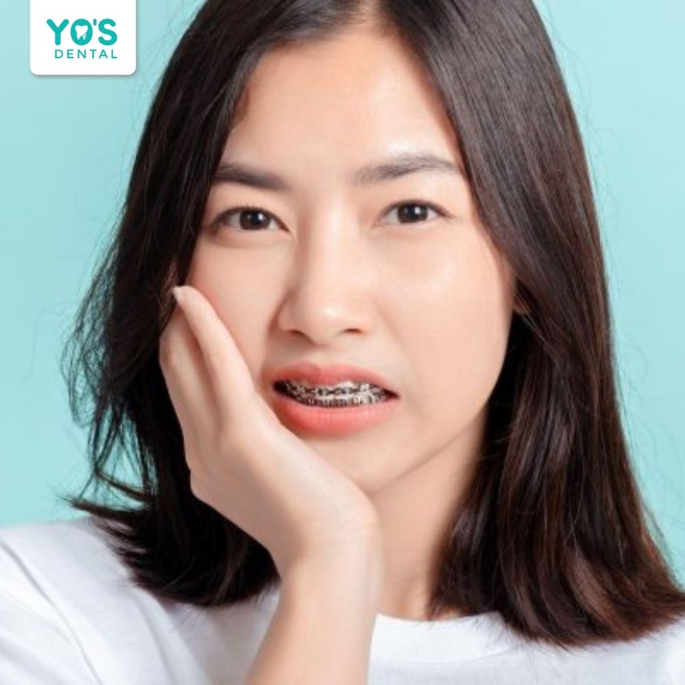 Dấu hiệu niềng răng hỏng thường gặp