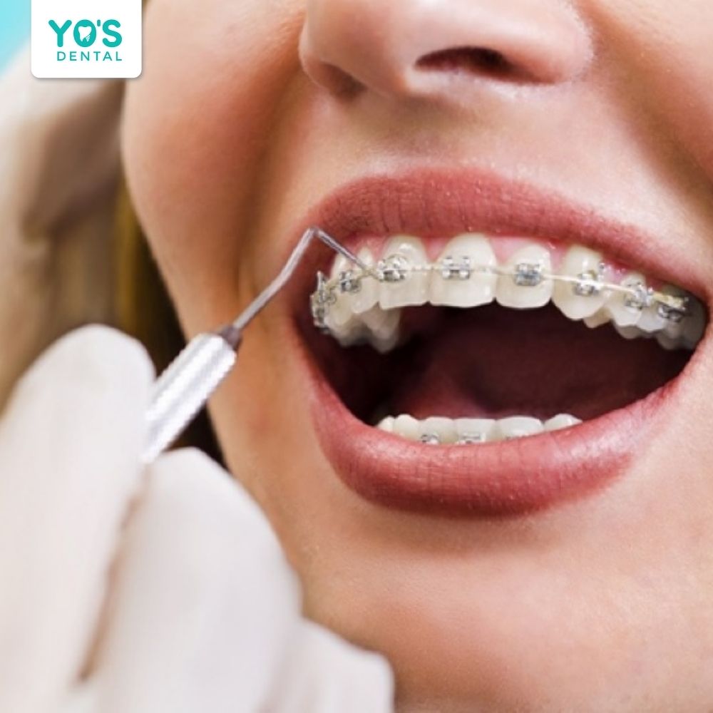 Khí cụ chỉnh nha kém chất lượng