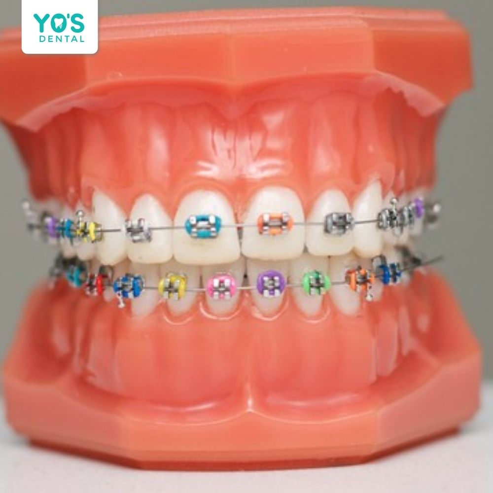 Vì sao xảy ra răng chạy lại sau khi niềng?