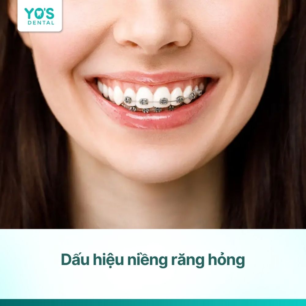 Dấu hiệu niềng răng hỏng: Cách nhận biết và khắc phục