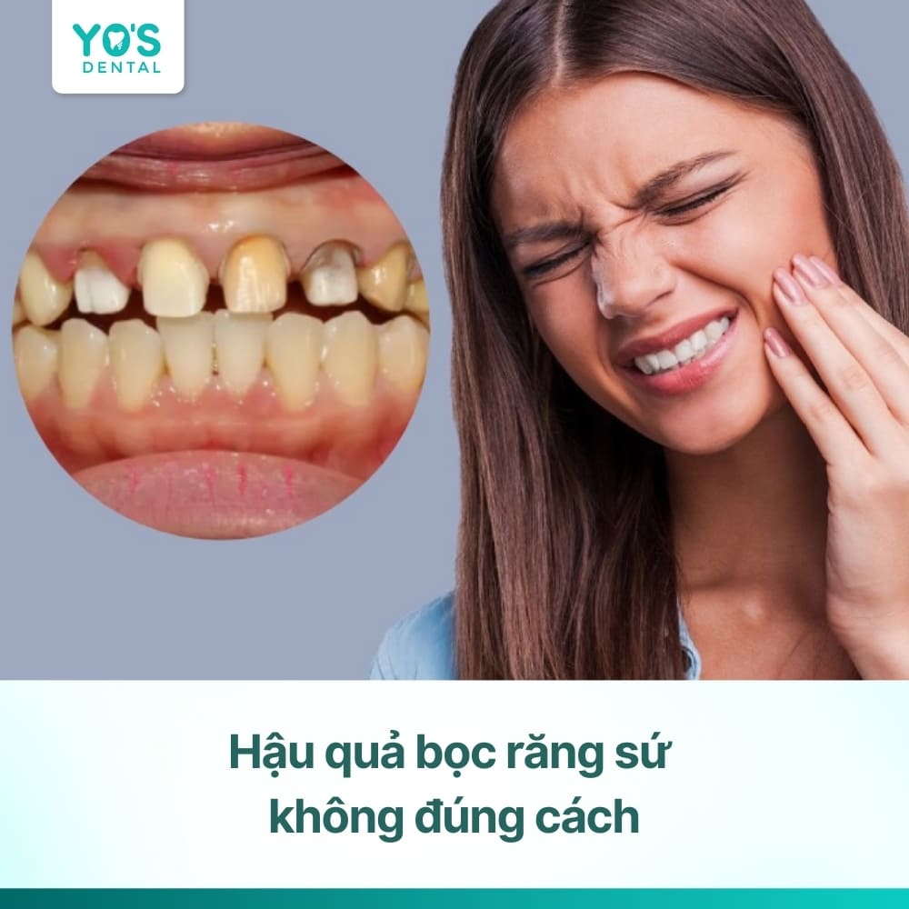 11 hậu quả bọc răng sứ cần cân nhắc trước khi thực hiện