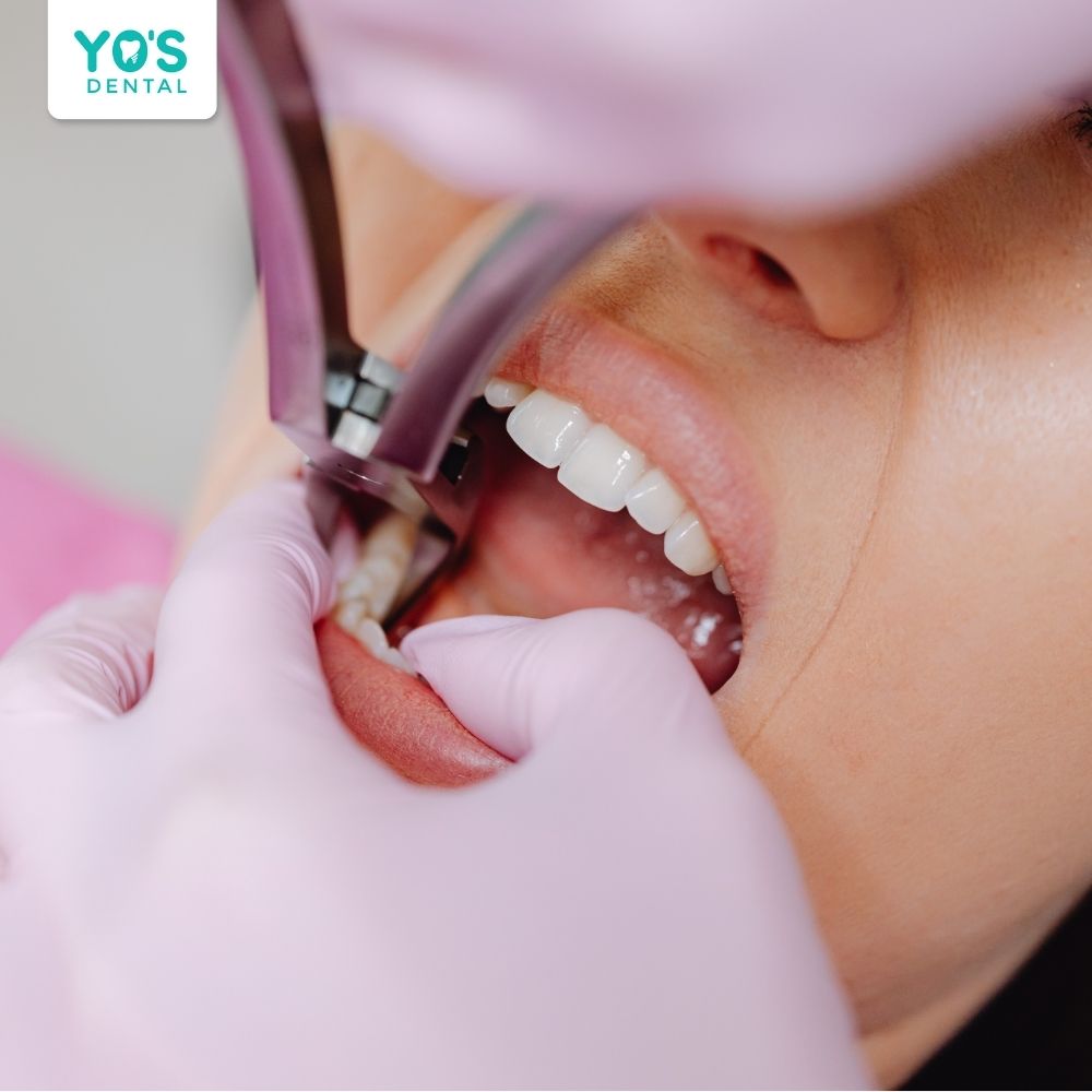 Lưu ý các trường hợp nên nhổ và có thể bảo tồn răng số 7