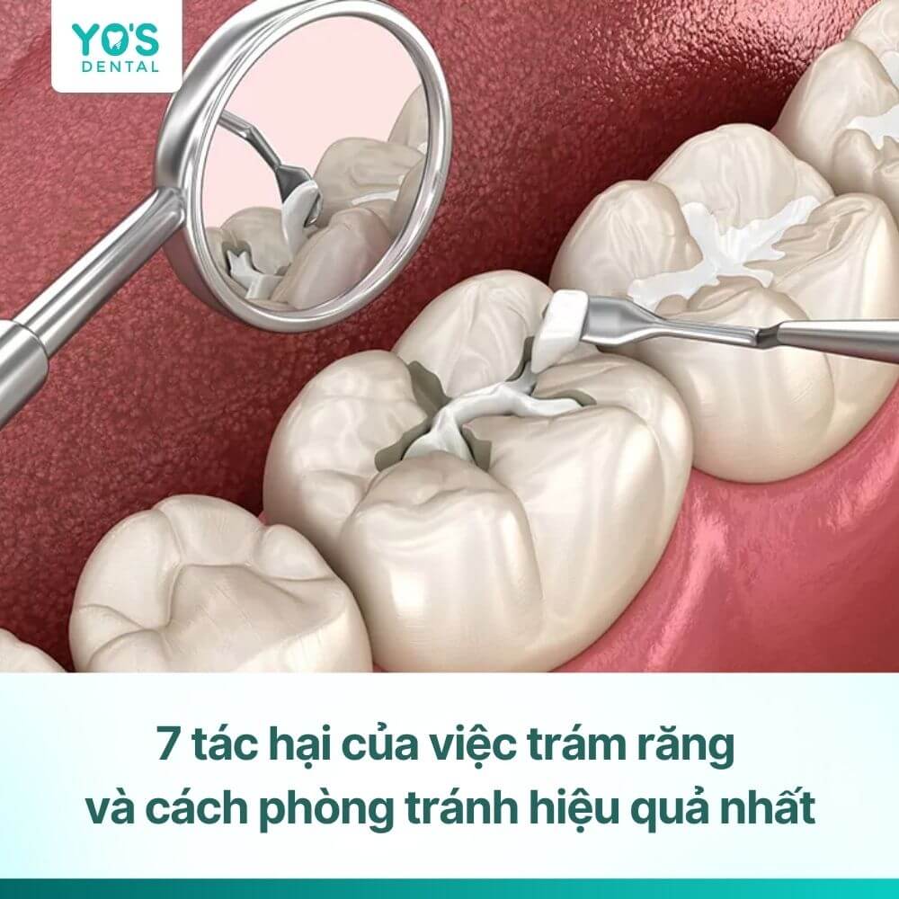 7 tác hại của việc trám răng và gợi ý cách phòng tránh hiệu quả