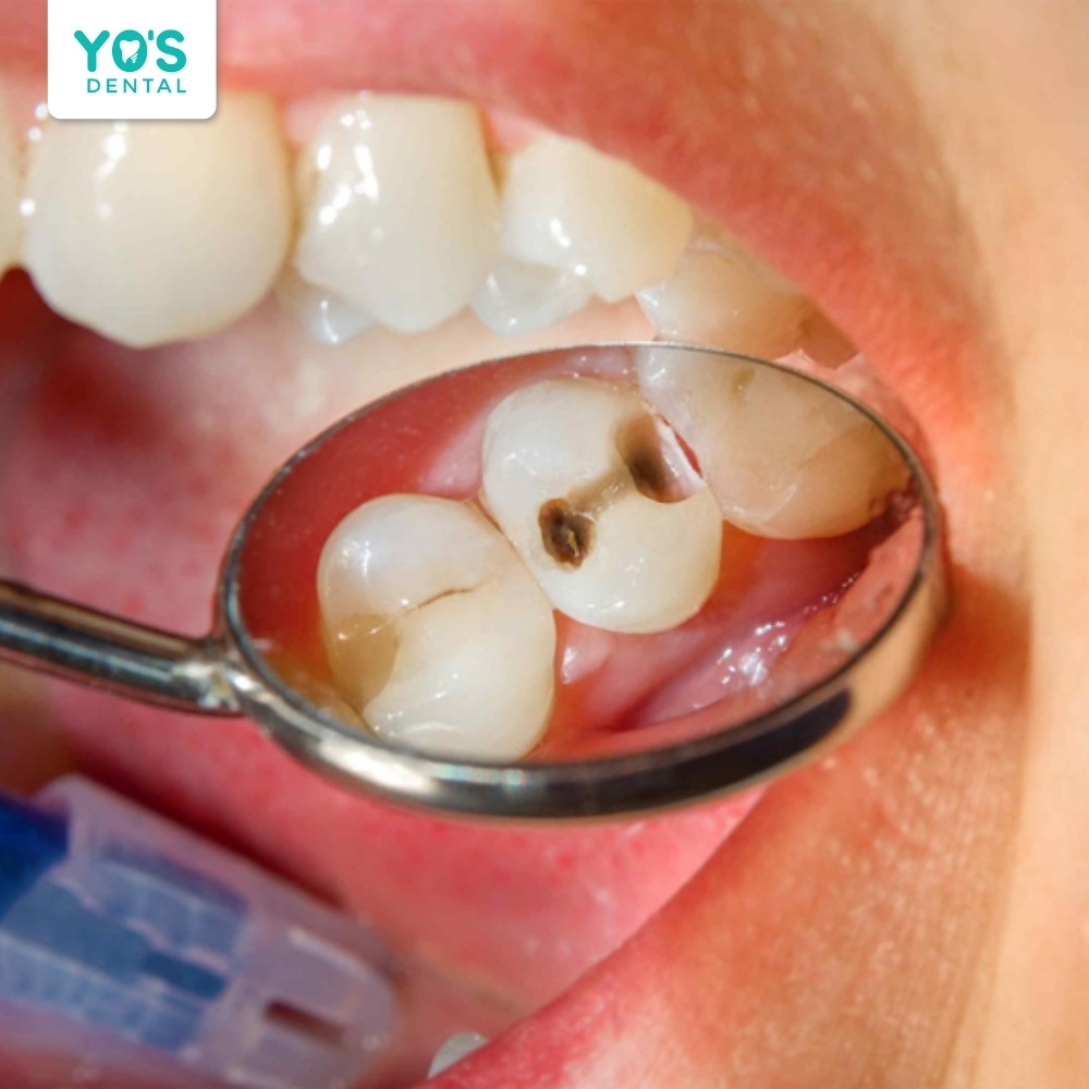 Tủy răng bị kích thích nhẹ vẫn còn khả năng phục hồi