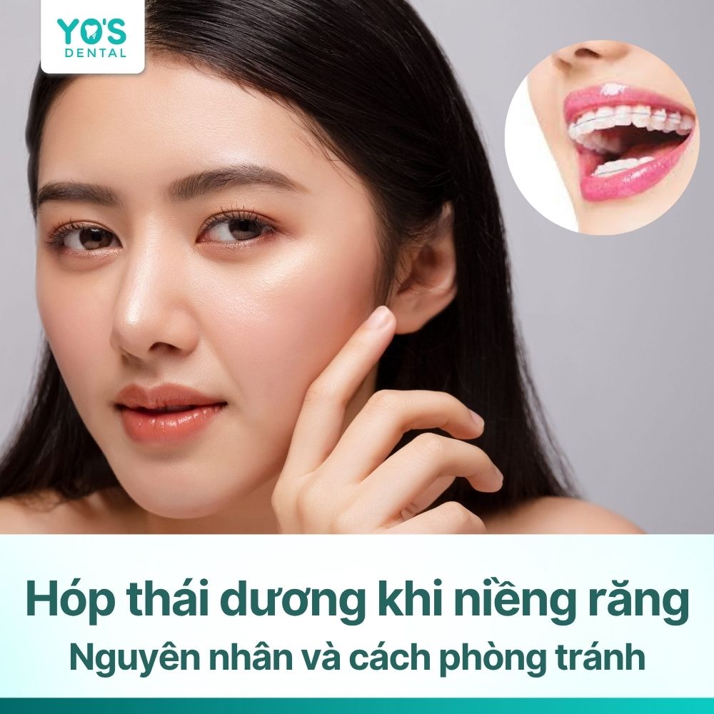 Hóp thái dương khi niềng răng: Nguyên nhân và cách phòng tránh