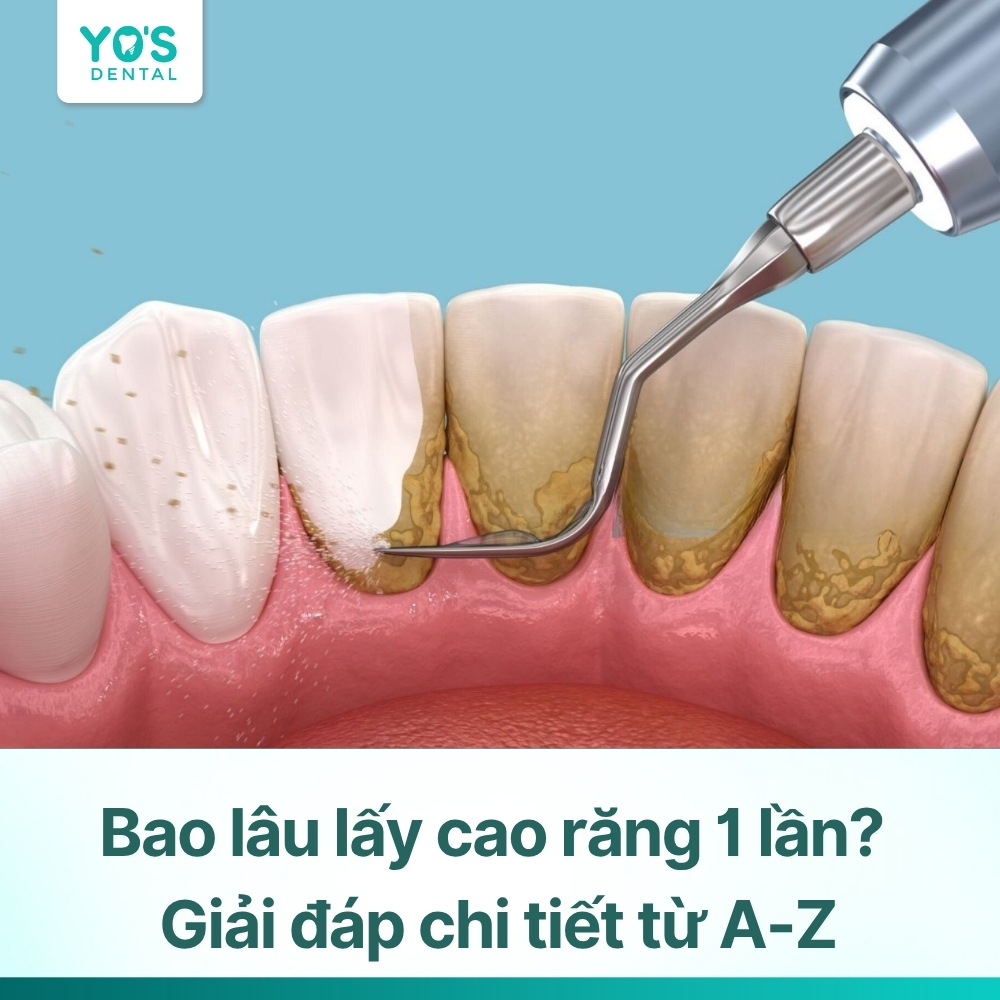 Bao lâu lấy cao răng 1 lần? Giải đáp chi tiết từ A-Z