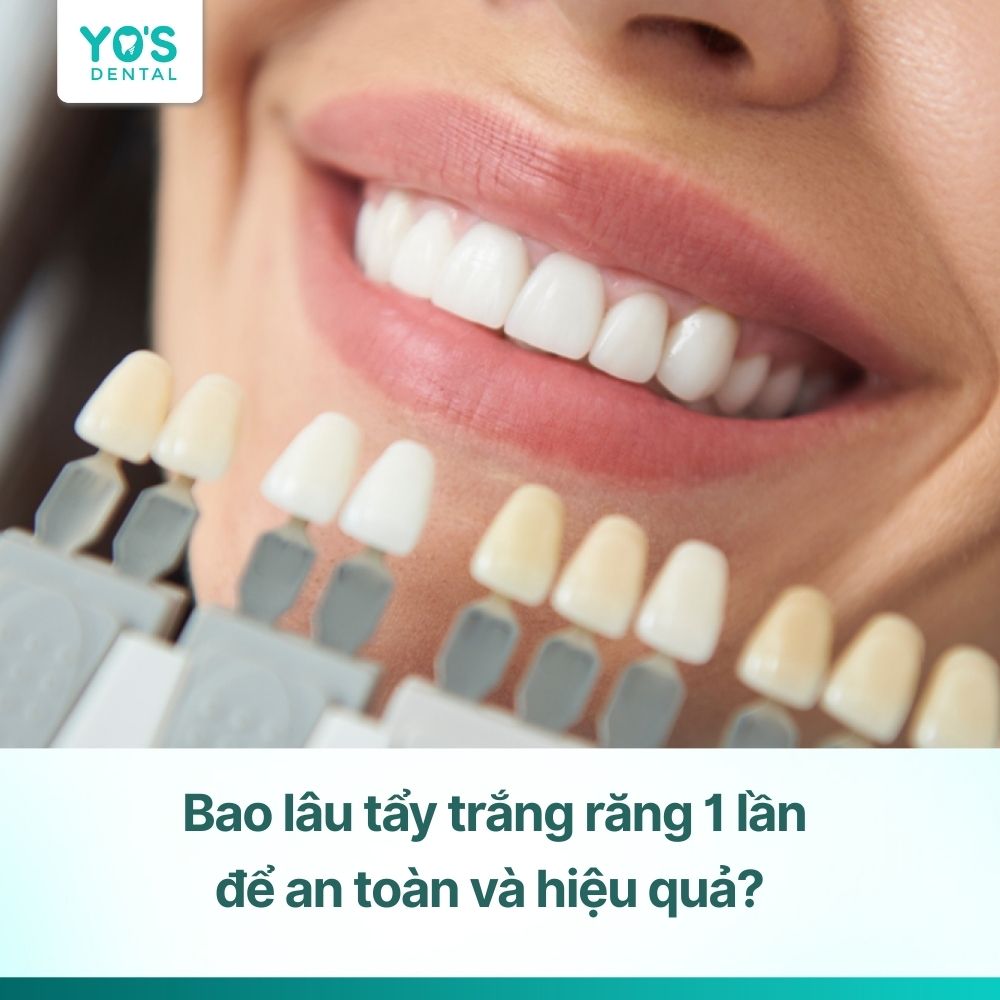 Bao lâu tẩy trắng răng 1 lần để an toàn và hiệu quả?