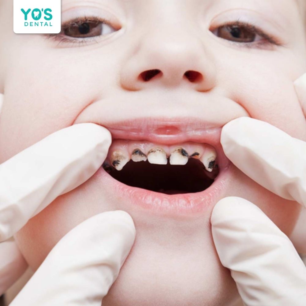 Trẻ bị sâu nhiều răng lan rộng thì cần chụp mão thép