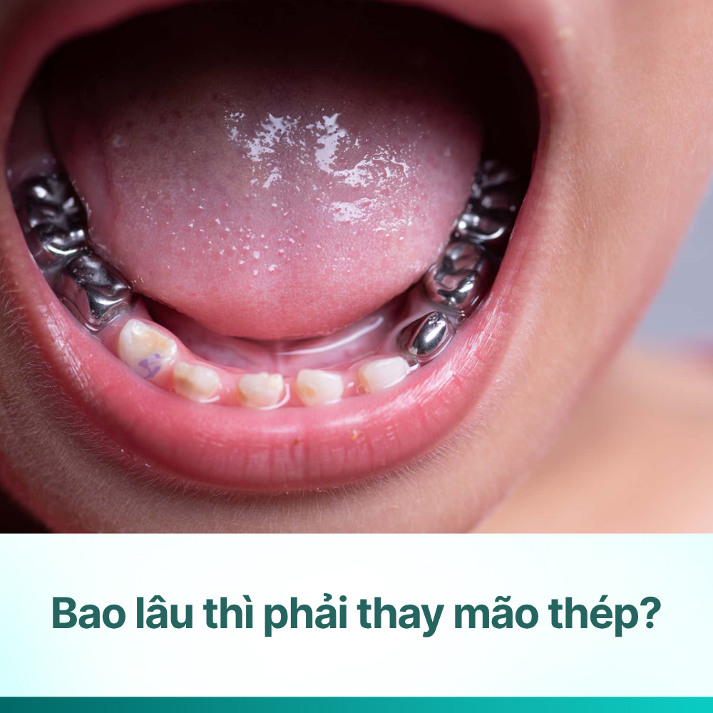Bao lâu thì phải thay mão thép răng sữa? Dấu hiệu & thời điểm
