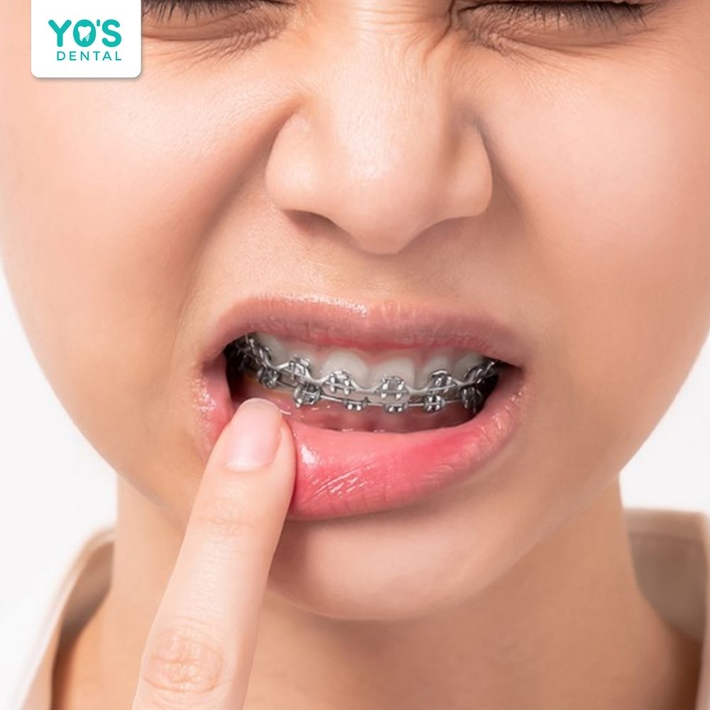 Gặp khó khăn khi ăn nhai nếu xảy ra tình trạng bật chân răng