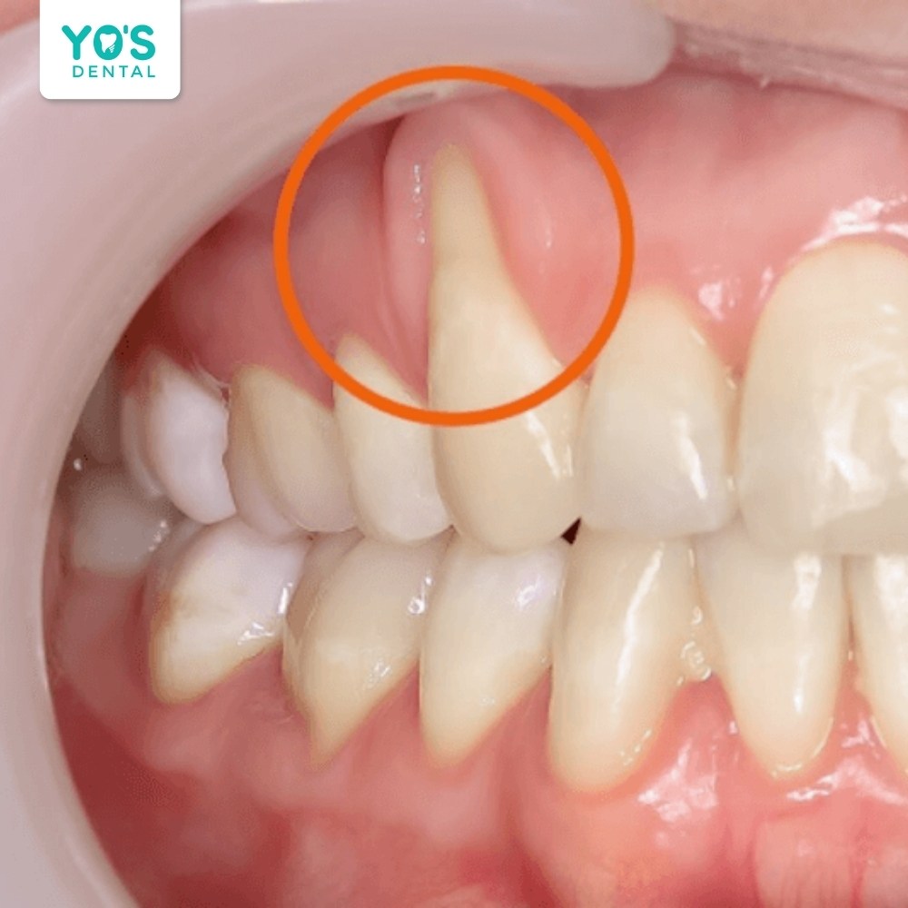 Lực tác dụng mạnh khiến niềng răng bị lòi chân răng