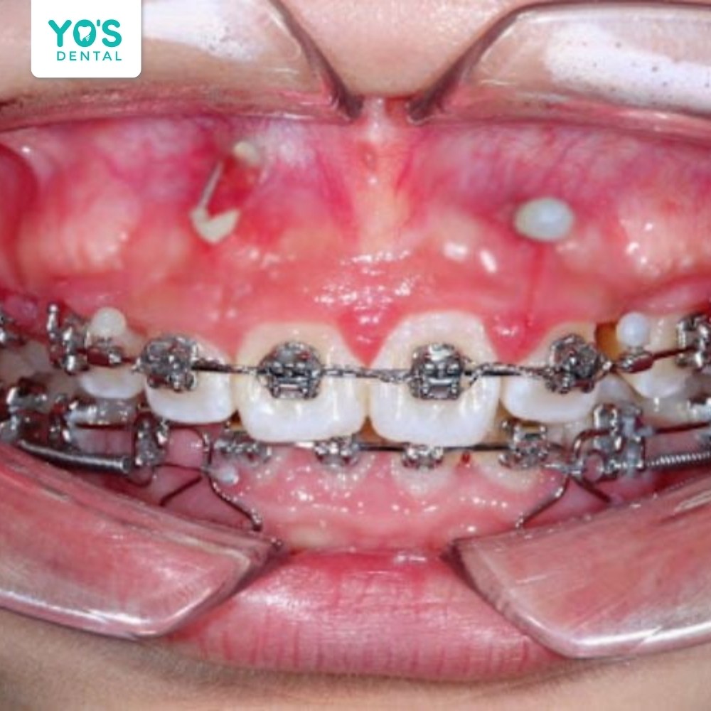Kỹ thuật niềng sai cách khiến chân răng bị bật