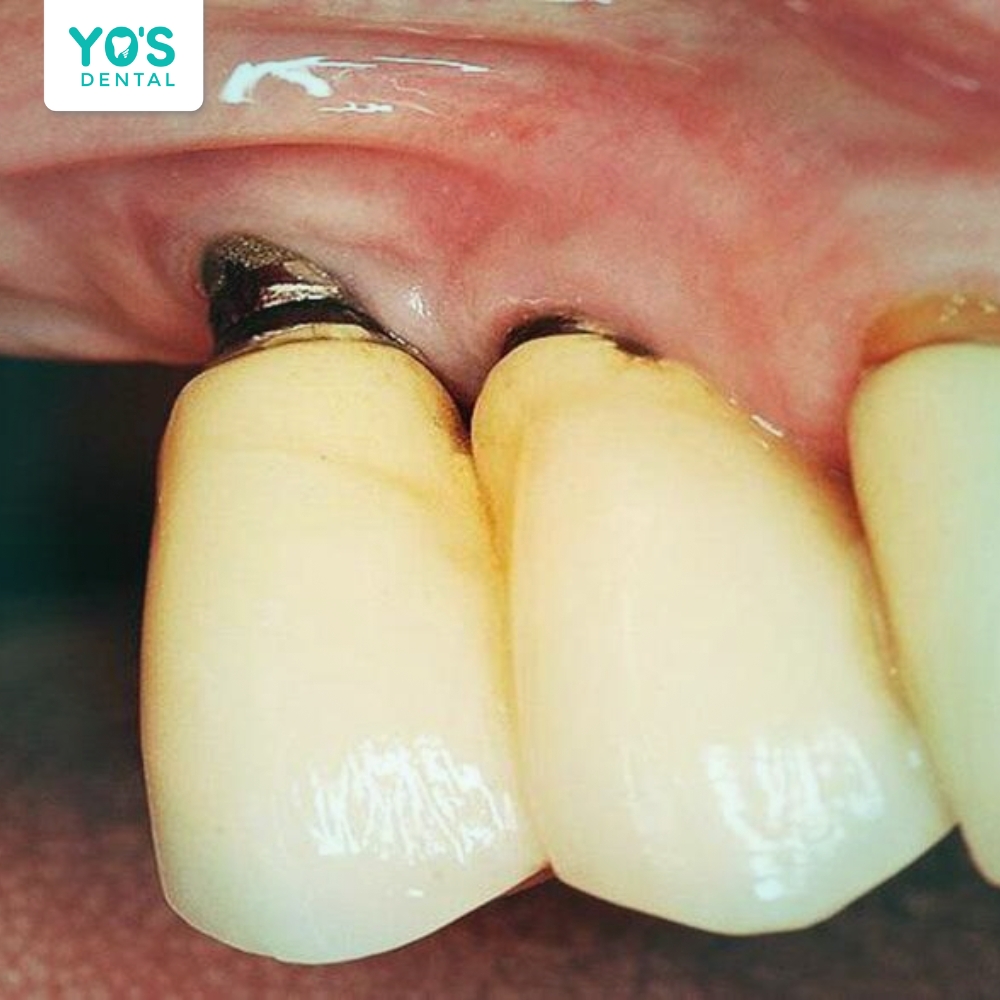 Nhiễm trùng là một trong những biến chứng phổ biến nhất sau khi cấy ghép implant