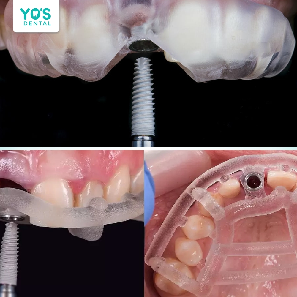 Cấy ghép lại Implant sau khi đã điều trị biến chứng