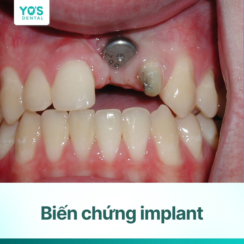 Biến chứng Implant: Các rủi ro, nguyên nhân và cách phòng tránh hiệu quả