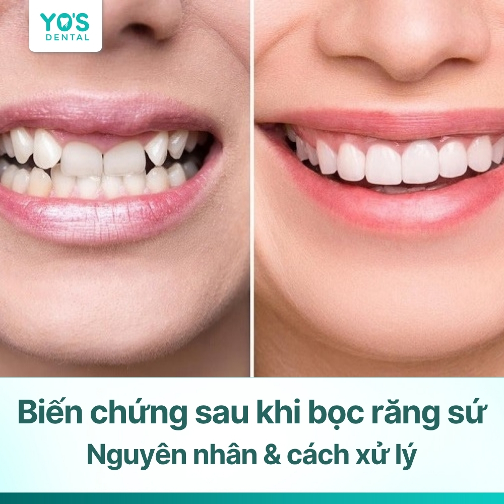Biến chứng sau khi bọc răng sứ: Nguyên nhân & cách xử lý