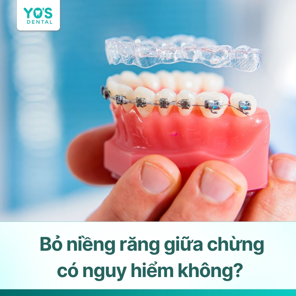Bỏ niềng răng giữa chừng: Những điều cần biết để tránh rủi ro