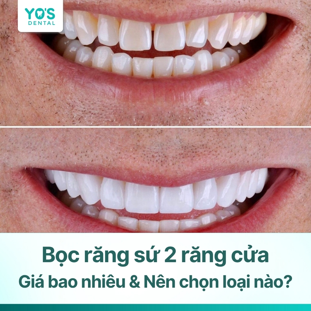 Bọc răng sứ 2 răng cửa: Giá bao nhiêu & Nên chọn loại nào?