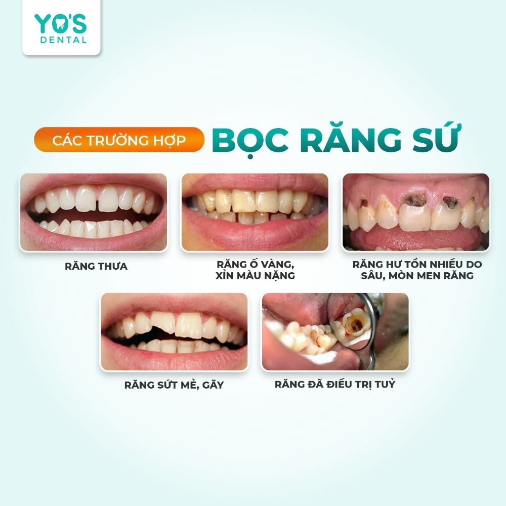 Bọc răng sứ chất lượng cao giúp khắc phục nhiều vấn đề răng miệng