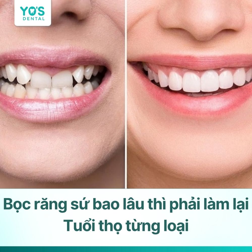 Bọc răng sứ bao lâu thì phải làm lại & Tuổi thọ từng loại