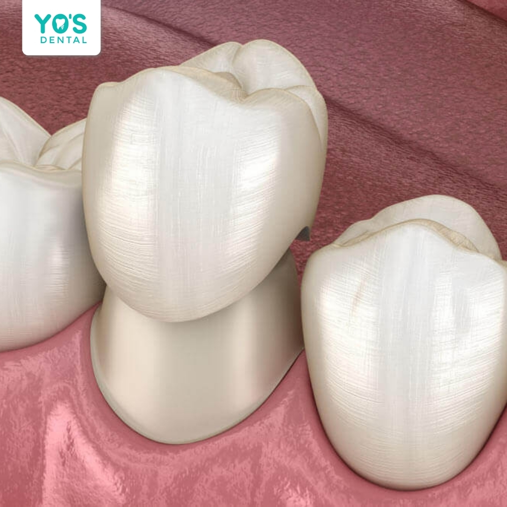 Cùi răng thật khỏe mạnh là nền tảng vững chắc giúp mão sứ bền và ổn định hơn