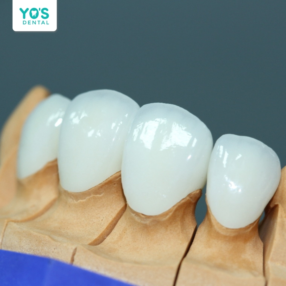 Răng toàn sứ có độ bền từ 15- 20 năm