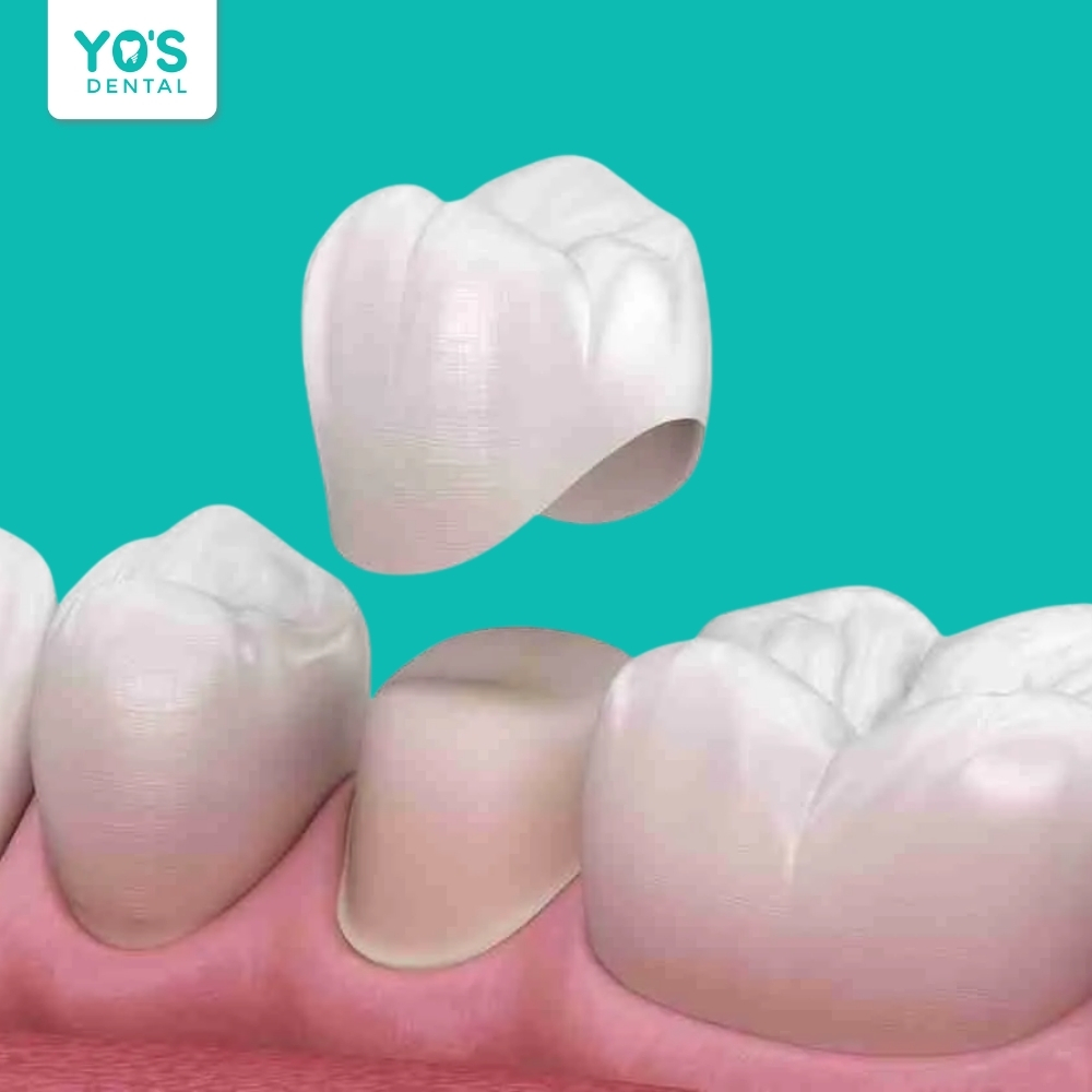 Nhiều yếu tố từ kỹ thuật đến thói quen xấu có thể gây đau răng sứ