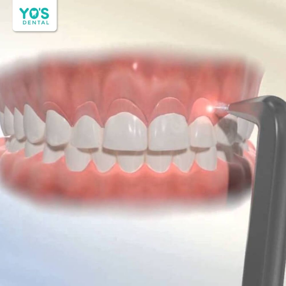 Quá trình điều trị nướu bị đen bằng công nghệ laser, giúp khôi phục màu sắc tự nhiên và cải thiện sức khỏe nướu
