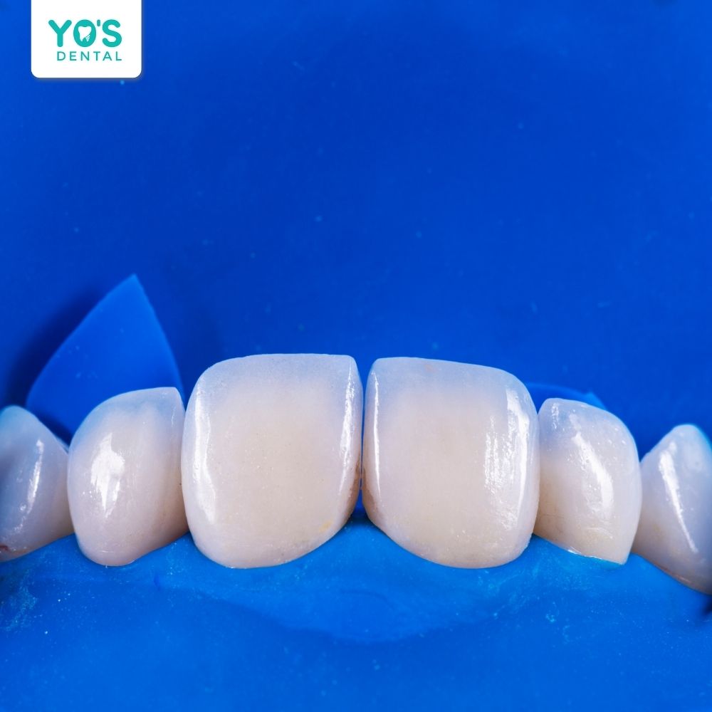 Bọc răng sứ đúng kỹ thuật không gây ra hôi miệng