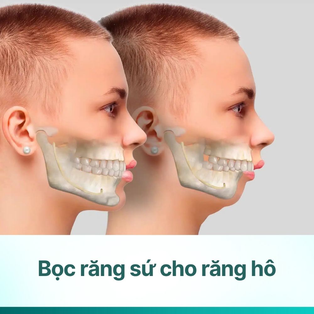 Bọc răng sứ cho răng hô: Khi nào nên và không nên thực hiện?
