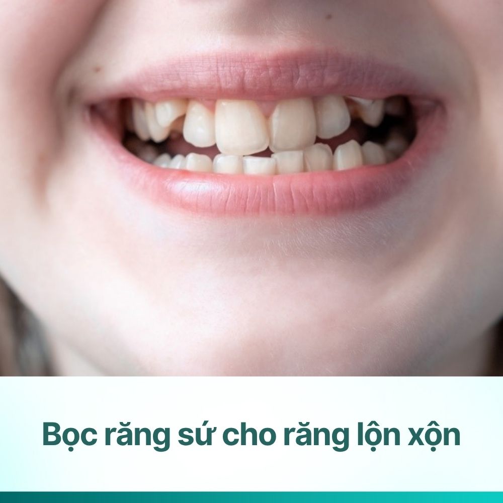 Giải đáp: Bọc răng sứ cho răng lộn xộn có được không?