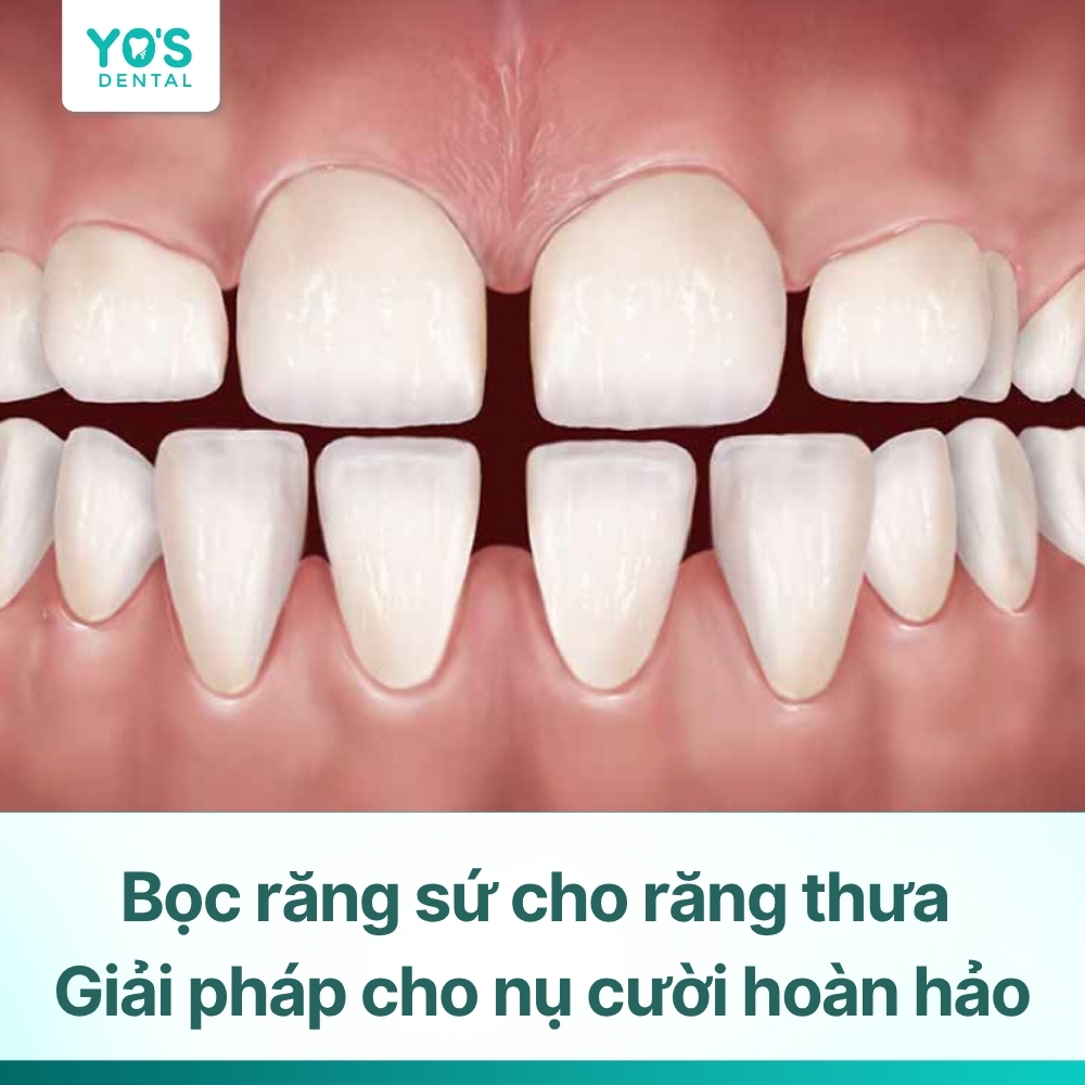 Bọc răng sứ cho răng thưa – Giải pháp cho nụ cười hoàn hảo