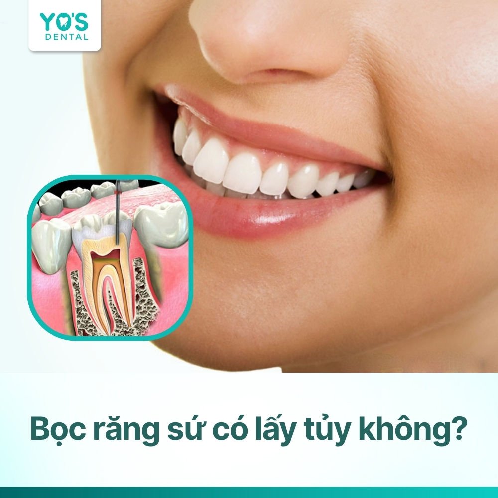 Bọc răng sứ có lấy tủy không? Khi nào cần & không cần?