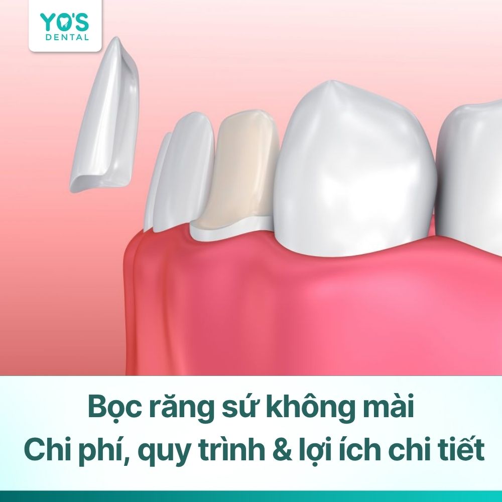 Bọc răng sứ không mài: Chi phí, quy trình & lợi ích chi tiết