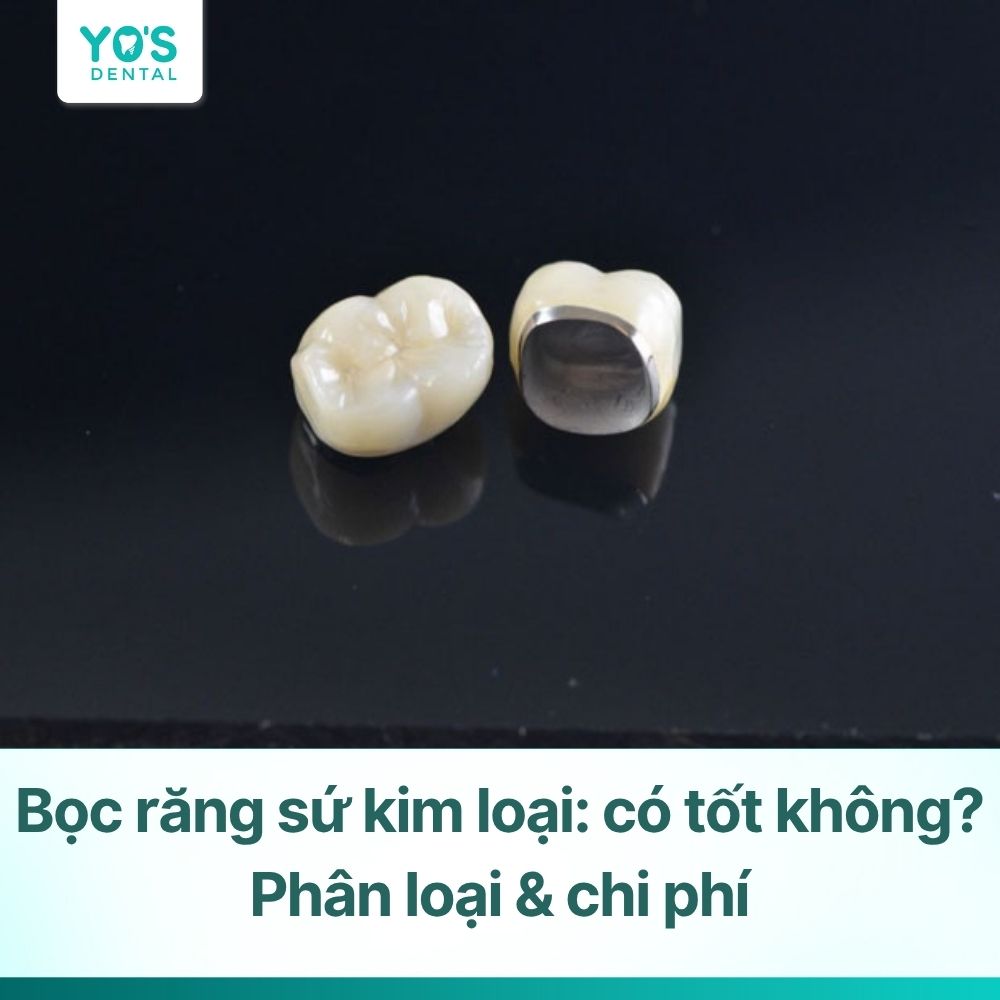 Bọc răng sứ kim loại: có tốt không? Phân loại & chi phí
