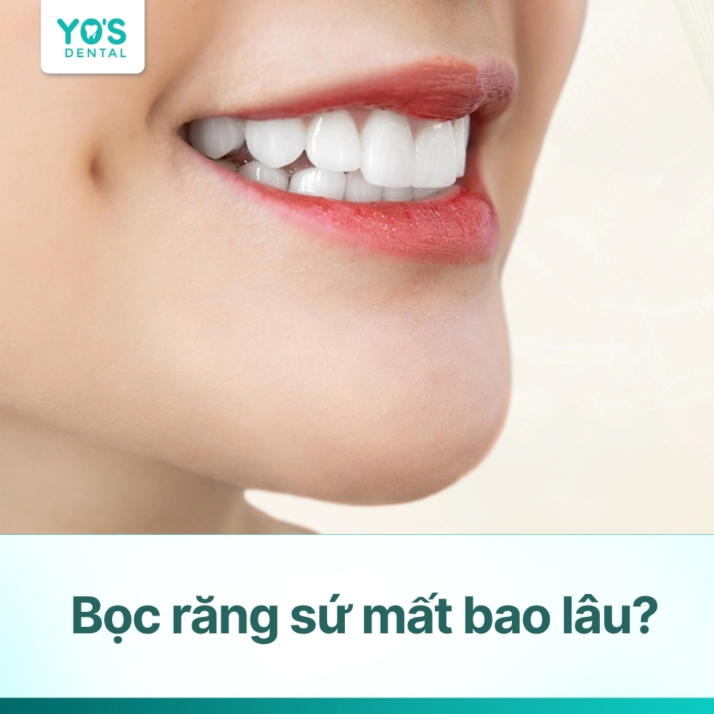 Bọc răng sứ mất bao lâu thì xong? Toàn bộ quy trình