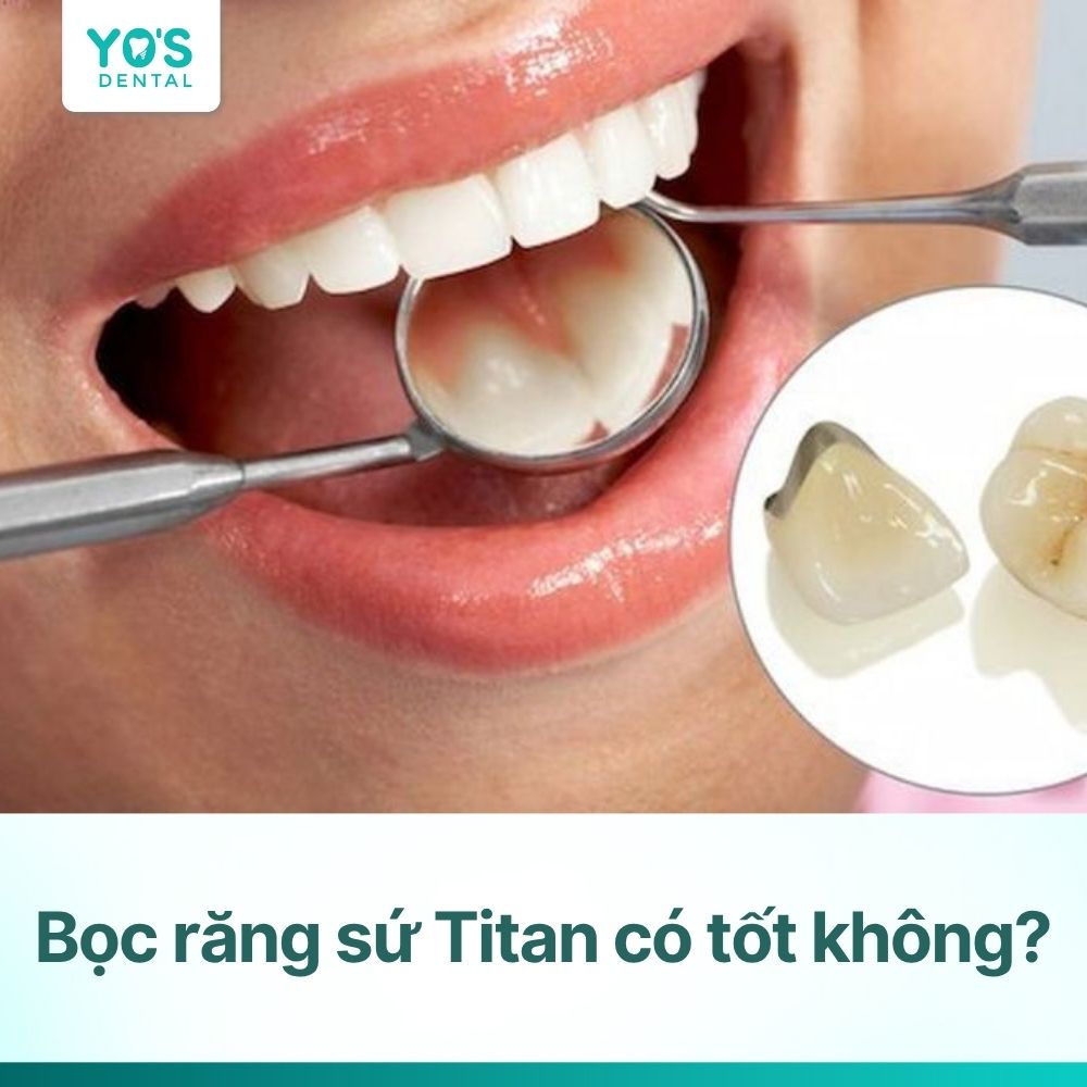 Bọc răng sứ Titan có tốt không? Dùng được bao lâu?