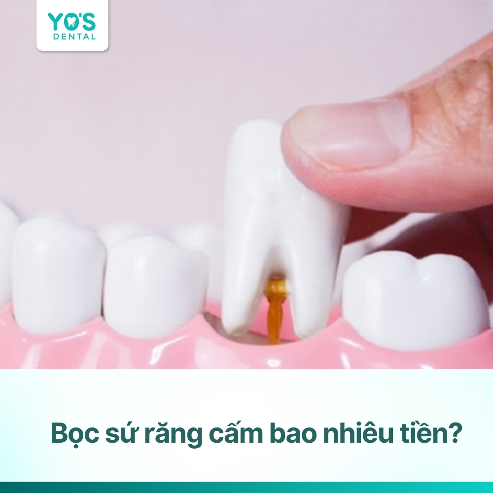 Bọc sứ răng cấm bao nhiêu tiền? Chọn loại nào bền, an toàn nhất?