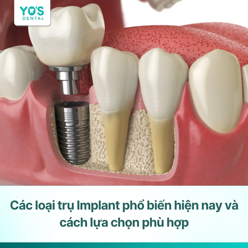 Các loại trụ Implant phổ biến hiện nay và cách lựa chọn phù hợp