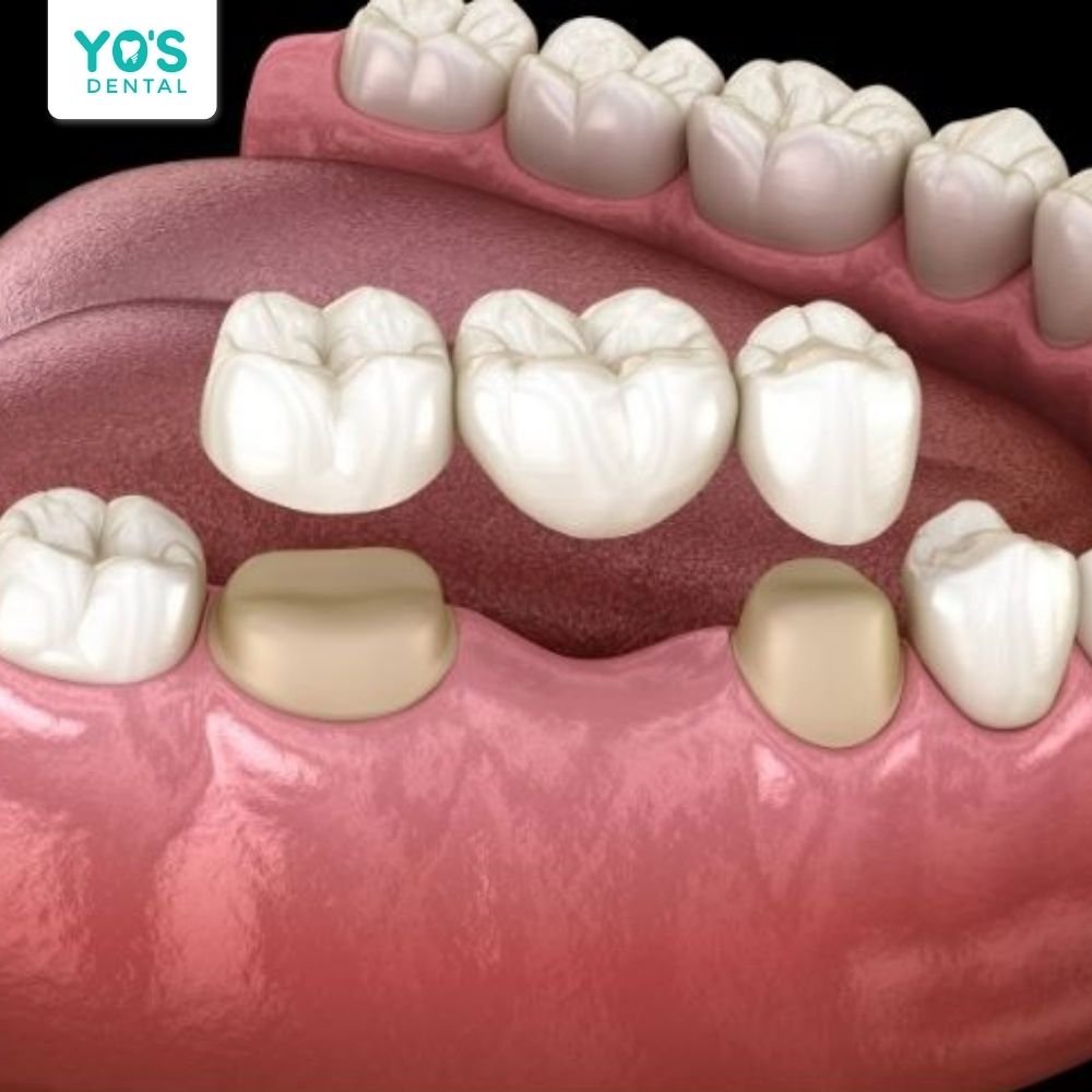 Hình ảnh cấu tạo cầu răng sứ gồm 2 mão trụ và 1-2 mão giả ở giữa