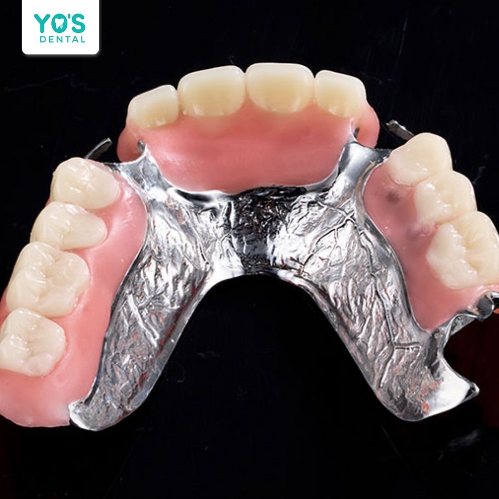 Khung hàm liên kết giúp giảm lực tác động lên các răng thật