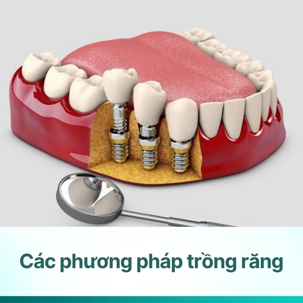 Các phương pháp trồng răng hiện nay: chọn loại nào tốt nhất?