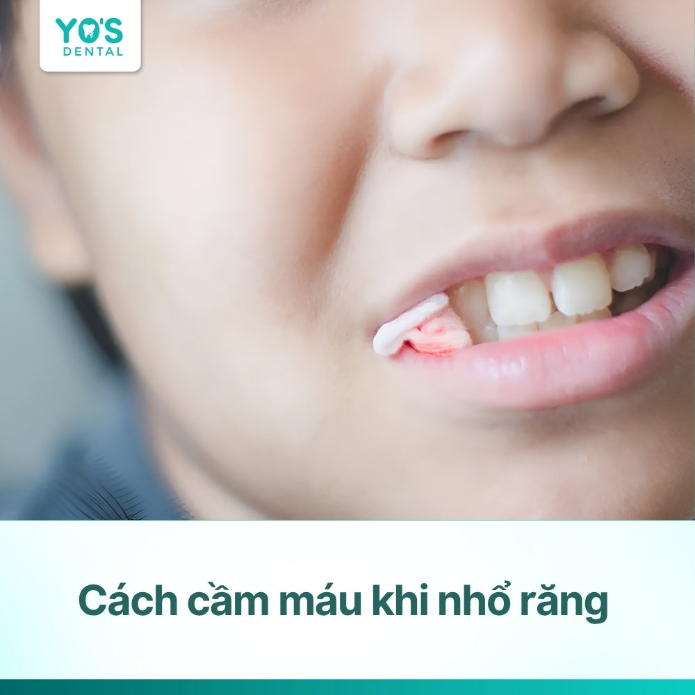 Cách cầm máu khi nhổ răng an toàn, giúp lành thương nhanh