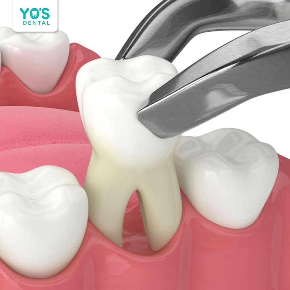Trong quá trình nhổ răng, nhờ có thuốc tê nên bạn sẽ không bị đau