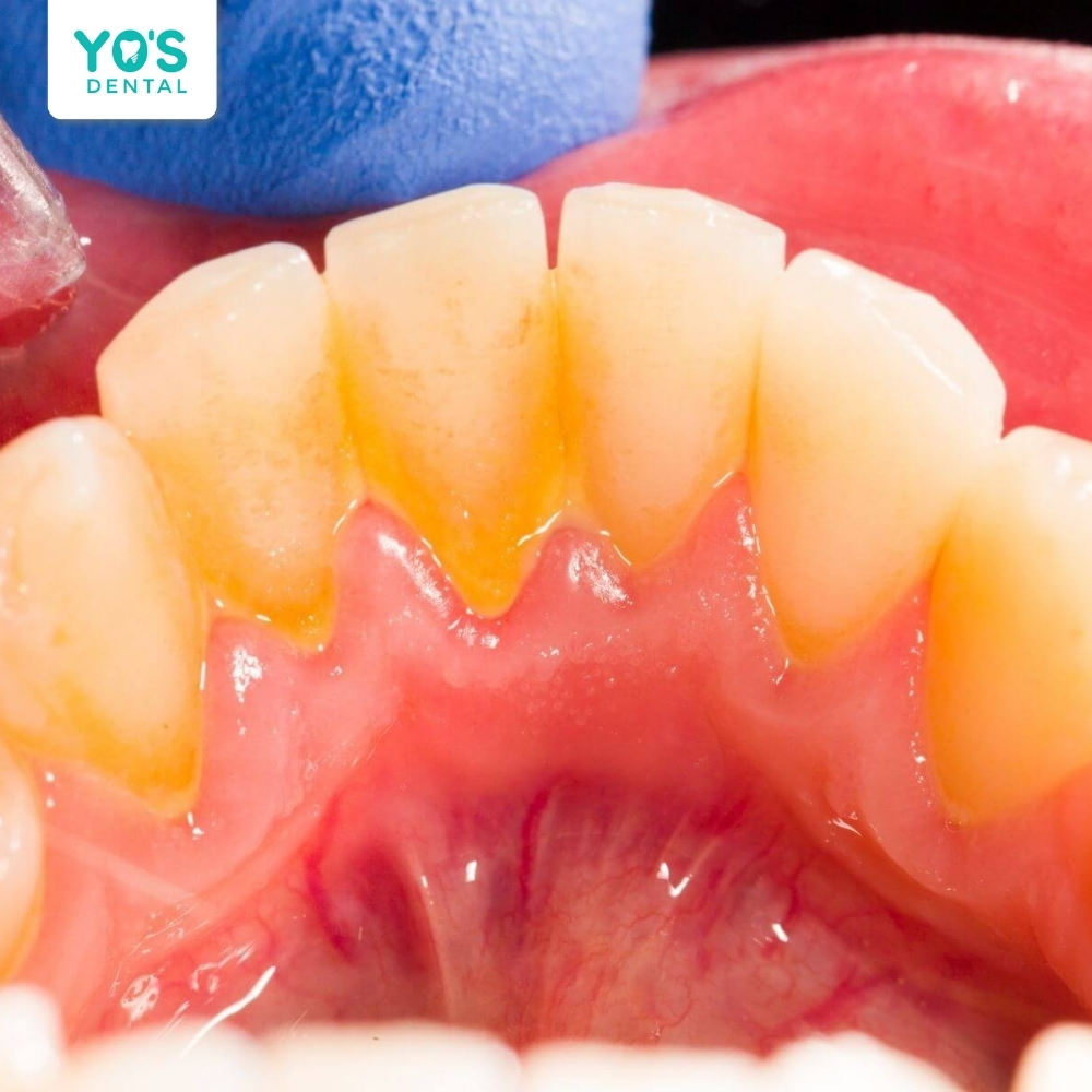 Cao răng là các mảng bám vôi hóa cứng cần được loại bỏ