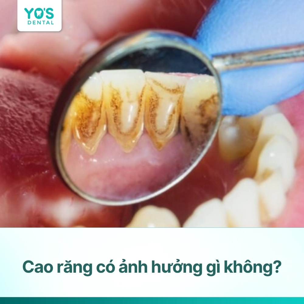 Cao răng có ảnh hưởng gì không và khi nào cần lấy cao răng?