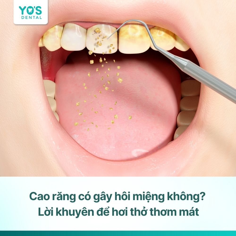 Cao răng có gây hôi miệng không? Lời khuyên để hơi thở thơm mát