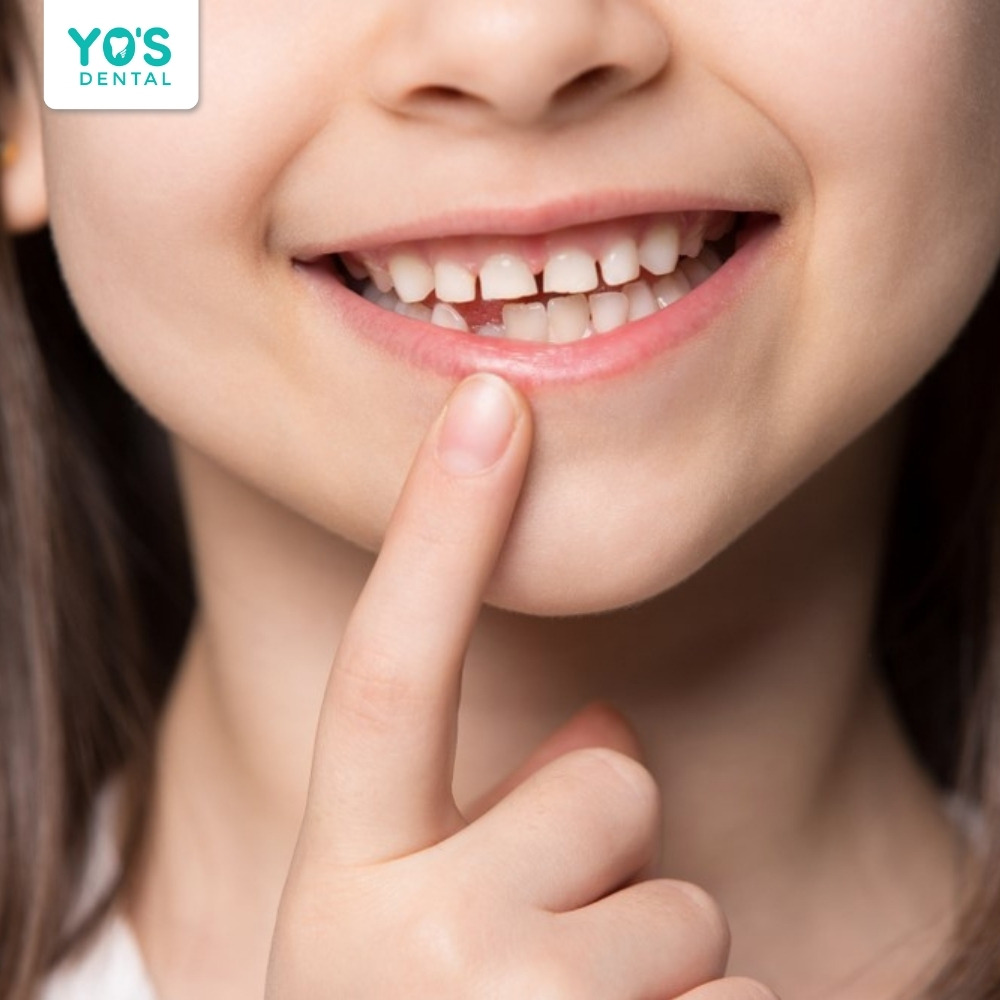 Trẻ em dưới 6 tuổi không được chỉ định lấy cao răng