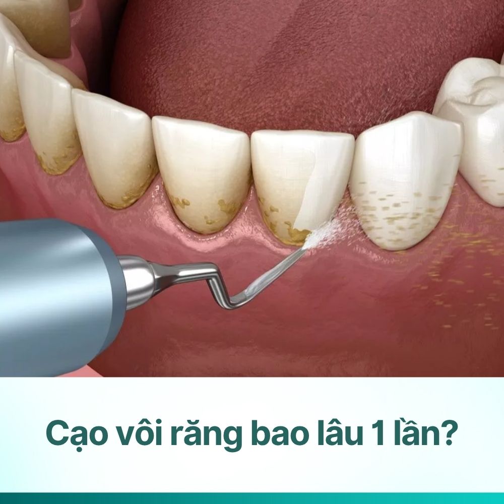 Cạo vôi răng bao lâu 1 lần? Lời khuyên từ bác sĩ